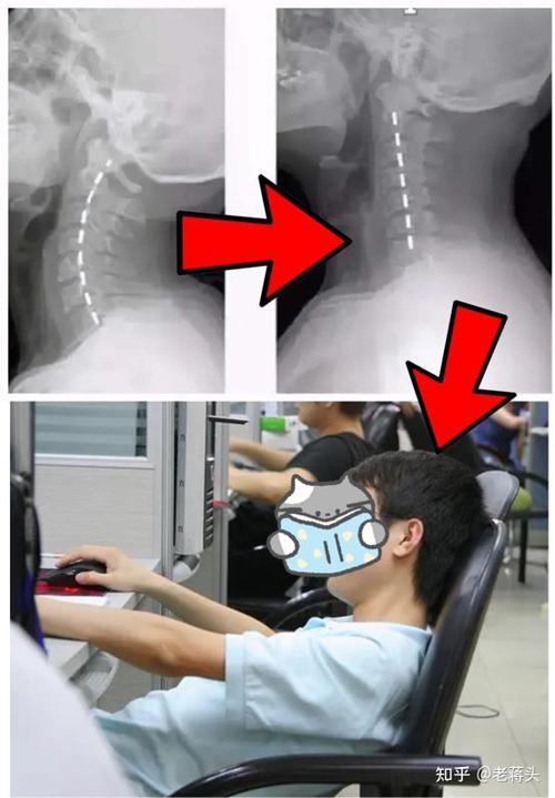 武汉上班族颈椎危机？程序员小王的真实经历与探寻